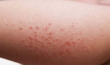 vnější projevy přítomnosti parazitů v těle