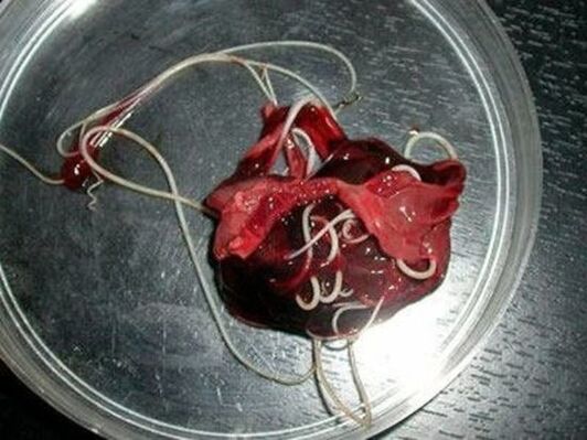 červy z lidského těla